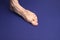 A man foot with a mesh of dilated varicose veins stands on a blue background