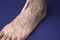 A man foot with a mesh of dilated varicose veins stands on a blue background