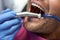 Man getting his teeth fixed at dental clinic