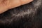 Man hair line showing hair root with dandruff