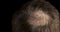 Man with hair loss problems closeup, isolated. Alopecia balding hairs on man scalp.