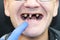 The man has rotten teeth, teeth fell out, yellow and black teeth hurt. Poor teeth condition, erosion, caries. The doctor prepares