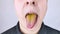 The man has a yellow tongue. Painful yellow coating on the mucous membrane of the tongue. Diseases of the gastrointestinal tract,