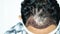 Man head with hair transplant surgery with receding hair line, FUE, Follicular unit extraction, Types of hair transplant