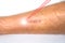 Man leg and laser beam during scar removal treatment. Laser resurfacing of scars