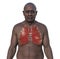 A man with lung miliary tuberculosis, 3D illustration