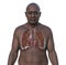 A man with lung miliary tuberculosis, 3D illustration