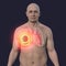 A man with lung mucormycosis lesion, 3D illustration