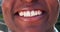 Man, mouth and teeth whitening with dental closeup, smile and health with happiness and face. Orthodontics, veneers and
