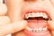 Man put orthodontic ring rubber string on braces