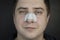 A man puts on and removes a strip for the nose from black dots. Coal cleaning strips from blackheads and comedones. The concept of