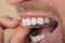 Man Putting Transparent Aligner In Teeth