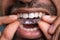 Man Putting Transparent Aligner In Teeth