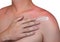 A man with reddened, itchy skin after sunburn applies a cream on the shoulder.