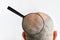 Man& x27;s bald flaky head with dandruff and zoomed with magnifier problem area, back view. White background. The concept