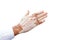 Man\'s hand with with vitiligo on white background