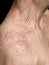 Man\'s Shoulder Covered With Skin Allergy