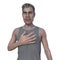 A man suffering from acromegaly, 3D illustration