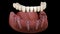 Mandibular prosthesis All on 4 system supported by implants. Medically accurate 3D animation of human teeth and dentures