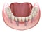 Mandibular prosthesis All on 4 system supported by implants. Medically accurate 3D illustration of human teeth