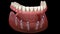 Mandibular prosthesis All on 6 system supported by implants