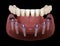 Mandibular prosthesis All on 6 system supported by implants. Medically accurate 3D illustration of human teeth