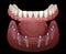 Mandibular prosthesis All on 8 system supported by implants. Medically accurate 3D illustration of human teeth