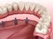 Mandibular prosthesis with gum All on 6 system supported by implants.  Medically accurate 3D illustration of human teeth