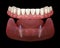 Mandibular removable prosthesis All on 2 system supported by implants with ball attachments. Medically accurate dental