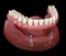 Mandibular removable prosthesis All on 2 system supported by implants with ball attachments. Medically accurate dental