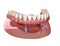 Mandibular removable prosthesis All on 2 system supported by implants with ball attachments. Medically accurate dental 3D