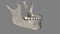 The mandibular third molar is also referred as the wisdom tooth