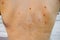 Many birthmarks on the girl`s back. Medical health photo. Woman`s oily skin with problems acne