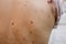 Many birthmarks on the girl`s back. Medical health photo. Woman`s oily skin with problems acne