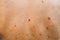 Many birthmarks on the girl`s back. Medical health photo. Woman`s oily skin with problems acne