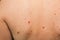 Many birthmarks on the girl`s back. Medical health photo. Woman`s oily skin with problems acne