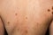 Many birthmarks on the girl`s back. Medical health photo. Woman`s oily skin with problems acne