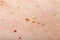 Many nevus and cherry angioma on human skin