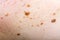 Many nevus on human skin