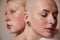 Masculine woman and womanly albino guy with feminine features