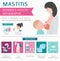 Mastitis, breastfeed, medical infographic. Diagnostics, symptoms