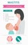 Mastitis, breastfeed, medical infographic. Diagnostics, symptoms