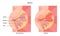 Mastitis. Mammary gland with inflammation of the breast lobular