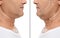 Mature man before and after plastic surgery operation on white background, closeup. Double chin