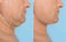 Mature man before and after surgery operation on blue background, closeup. Double chin problem