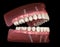Maxillary and Mandibular prosthesis with gum All on 4 system supported by implants. Medically accurate 3D illustration