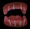 Maxillary and Mandibular prosthesis with gum All on 4 system supported by implants. Medically accurate 3D illustration