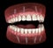 Maxillary and Mandibular prosthesis with gum All on 4 system supported by implants. Medically accurate 3D illustration