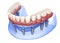 Maxillary and Mandibular prosthesis with gum All on 8 system supported by implants. Medically accurate 3D illustration of human