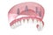 Maxillary prosthesis with gum All on 4 system supported by implants. Medically accurate 3D illustration of human teeth and